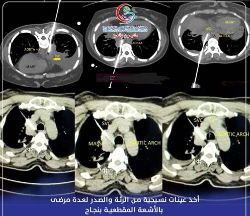 بالأشعة المقطعية أخذ عينات للفحص النسيجي من الصدر والرئة بنجاح